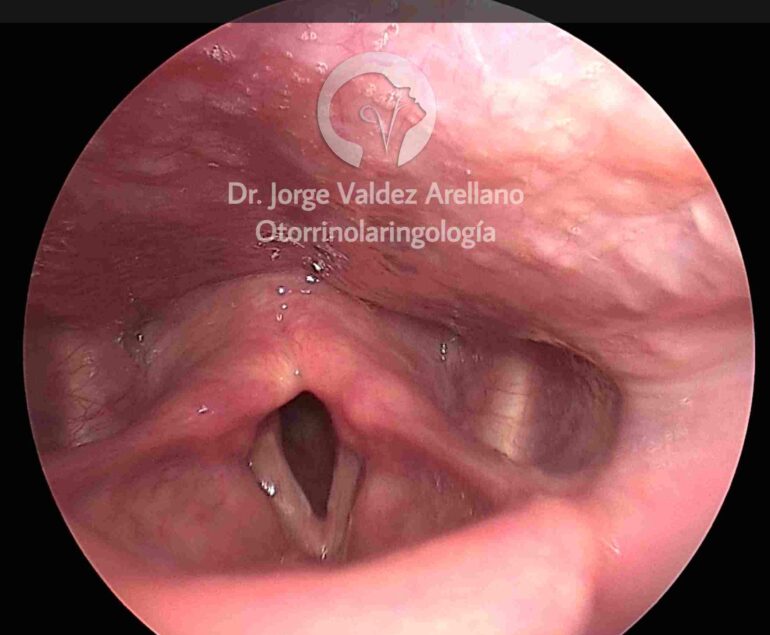 Laringología Se realizan consultas diagnósticas, nasofaringolaringoscopía, endoscopía de laringe en HD y cirugía de voz