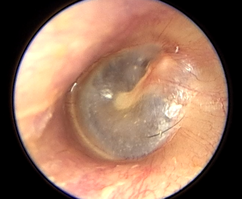Otología - Consulta y Cirugía de Oído