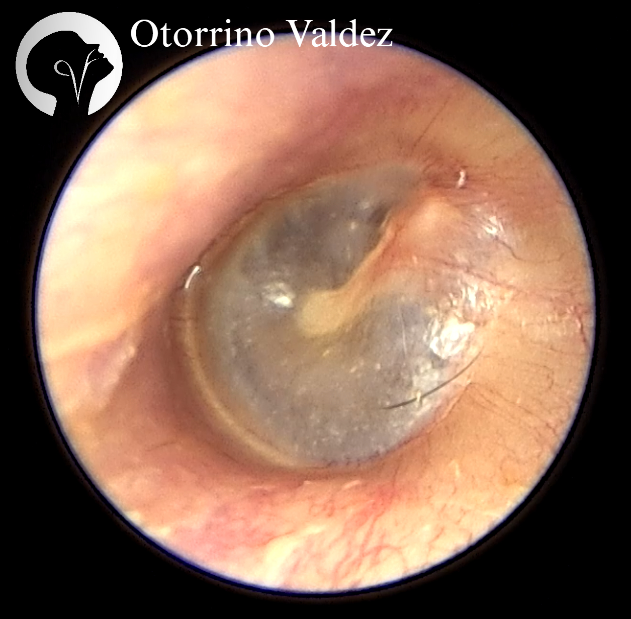 Otología - Consulta y Cirugía de Oído