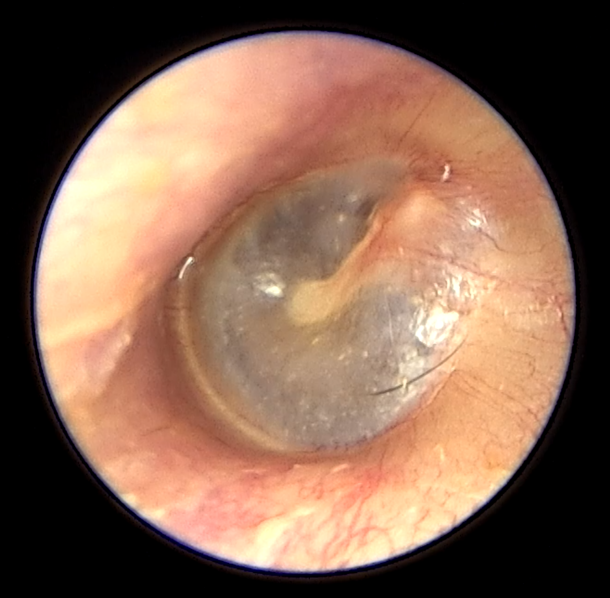 Otología - Consulta y Cirugía de Oído